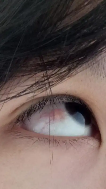 我的眼睛有红血丝好几天了,最近发现红血丝的上边有个泡