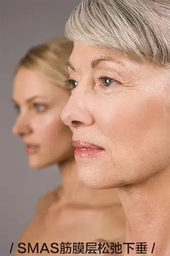 smas筋膜层松弛下垂