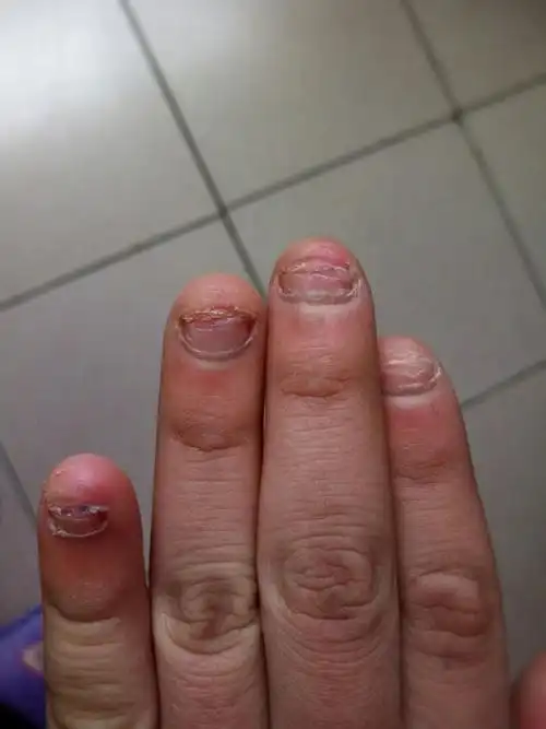 孩子很长一段时间喜欢啃指甲,指甲啃的凹凸不平 非常短,指甲都没长