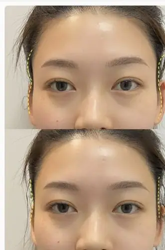 玻尿酸填充太阳穴前后对比图,参考一下