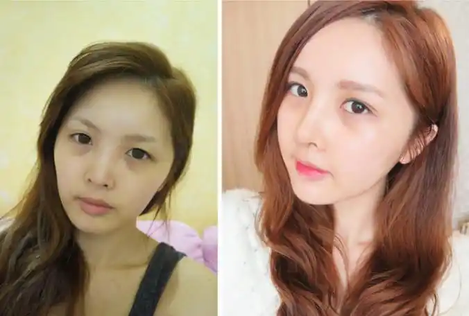 韩国自体脂肪填充和水光针可以同时治疗吗