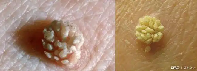 男性尖锐湿疣多发于阴茎,阴囊,尿道口和肛周等部位;女性生殖器疣则好