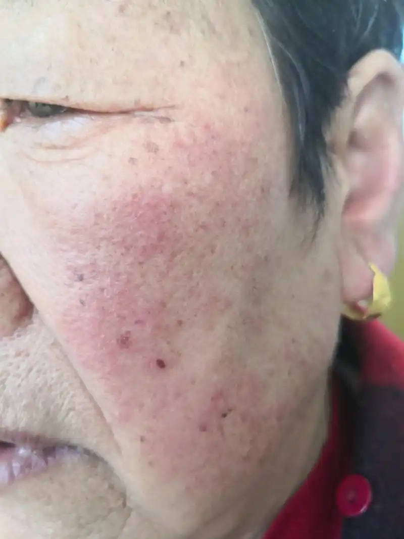 考虑接触性皮炎症状#过敏##解决皮肤问题专注皮肤美容##接触性皮炎