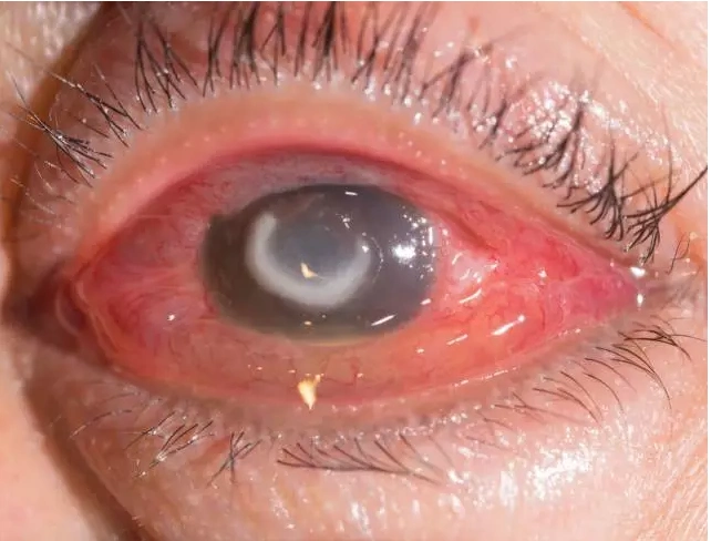 年代隐形眼镜被发明开始,角膜溃疡的发病率跟着它的普及一直在上涨