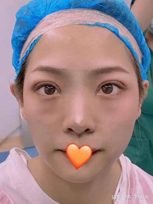 分享自己刚做的双眼皮