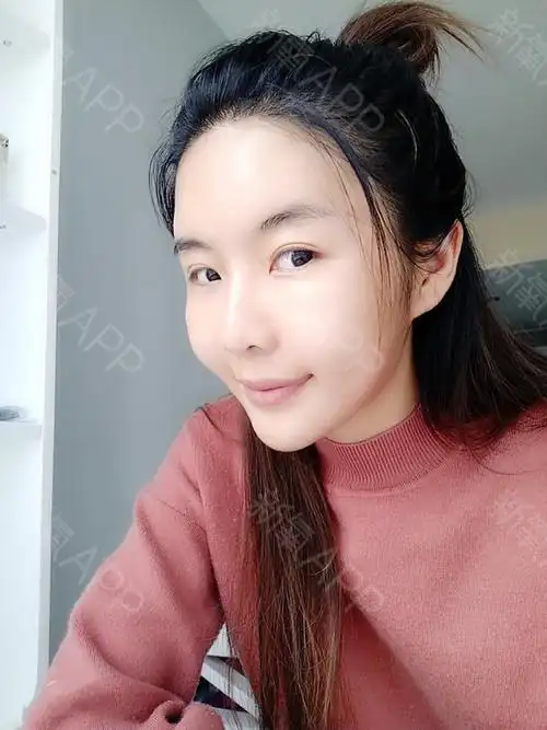 自体脂肪全脸填充好不好_效果图_繁花似锦w自体脂肪全脸填充术后第15