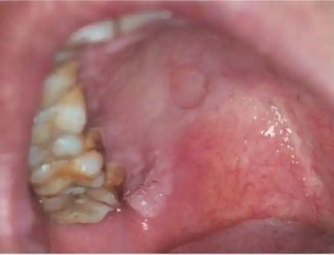 人得了一期梅毒图片