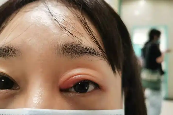 睑腺炎内眼角发炎红肿图