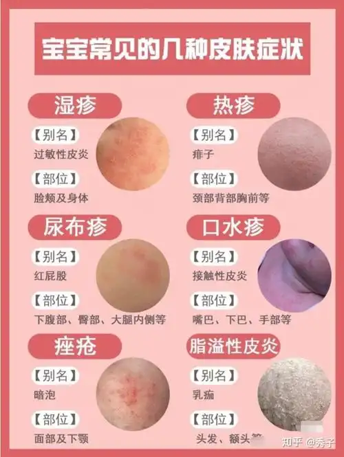 宝宝湿疹为什么总是治不好你是不是犯了这些错误