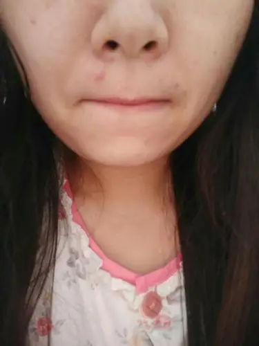 鼻子那得三角区总出疙瘩,痘痘,是什么引起的,是上火吗总出