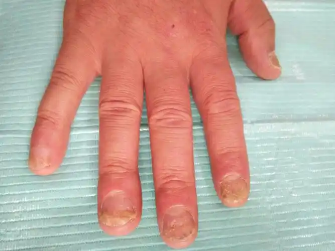 典型病例银屑病甲