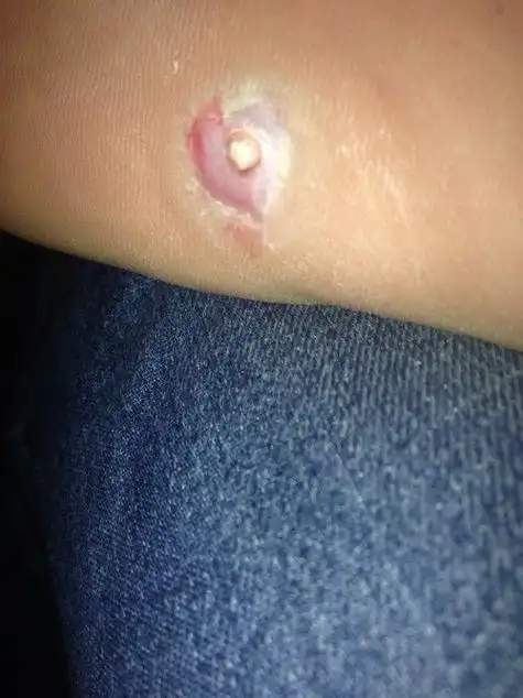 把鸡眼的一根须拽出来了,肉刺长什么样子图片_竞价网