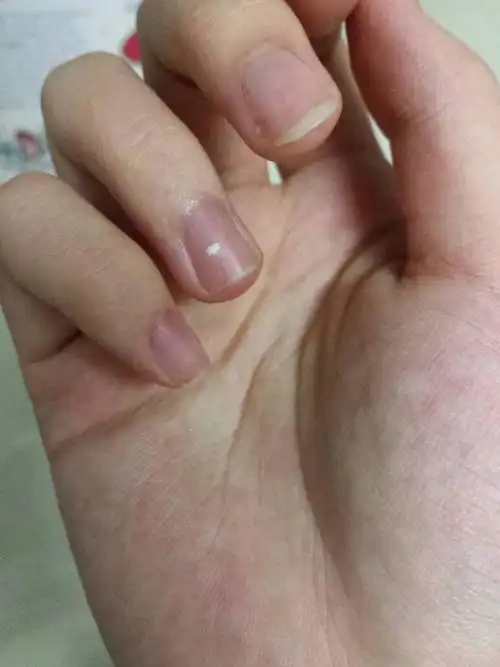 这是什么哇.近几天才刚发现指甲有个小白点,以前木有哇
