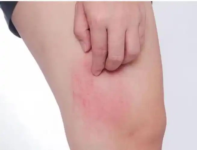 怎么判断是被跳蚤咬的_夏日怎么判断是被什么蚊子咬的