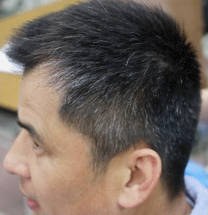 男人长白头发怎么办