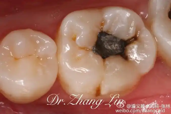 今日病例:左下第一磨牙继发龋,去除银汞充.