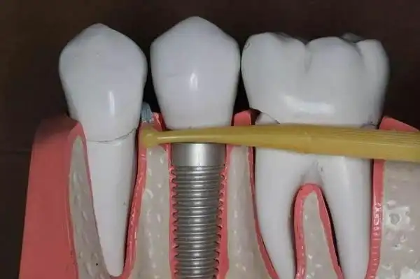 种植牙螺丝掉了怎么办