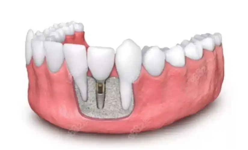 南京康美口腔种植牙怎么样种植牙技术好而且不贵