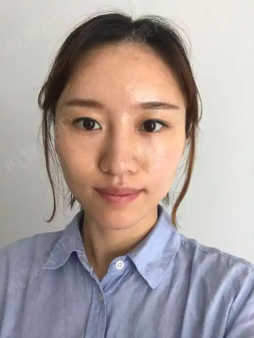 埋线提升术后3天_自体脂肪面部填充术后3天_面部填充术后3天_紧致提升