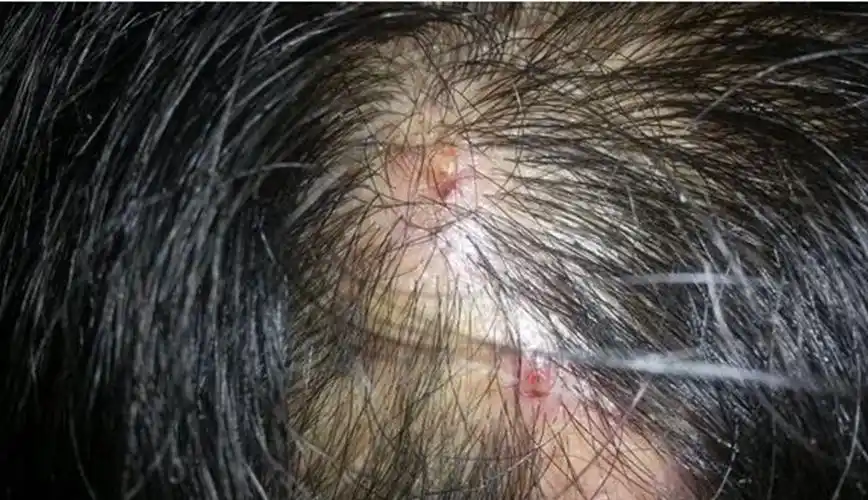 头癣图片_头癣症状表现图片大全_有来医生