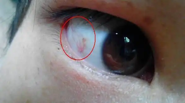 身体出现这5个症状说明贫血,超过两个就要补血了