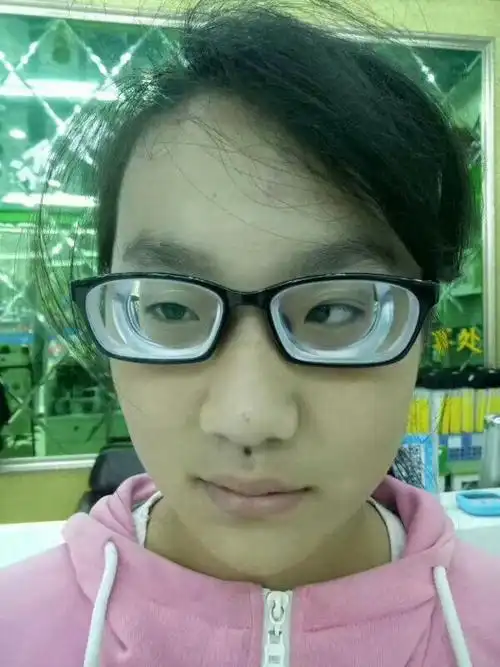 高度近视引起的斜视高度近视到晚年几乎全部失明再漂亮的人也靠不住