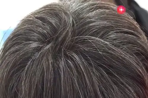 14岁男孩满头白发,母亲四处求医,专家的话让其愣住了