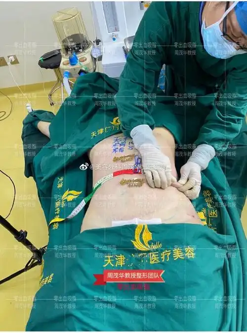 吸脂##腰腹吸脂##腰腹环吸