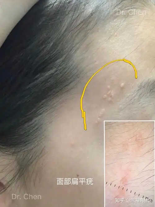 实际上这两种疣大片对称的发生于颈部是很少见的.