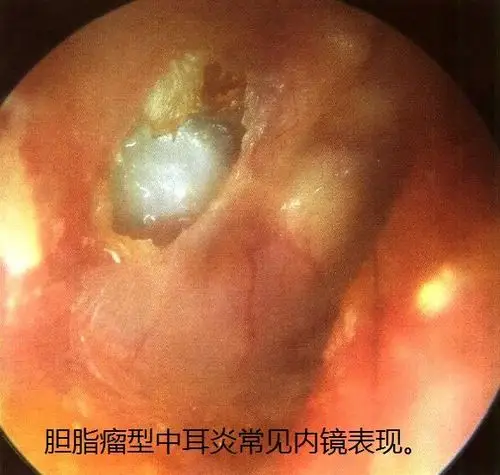 慢性中耳临床表现及诊疗_中耳炎_症状_症状表现 - 好大夫在线
