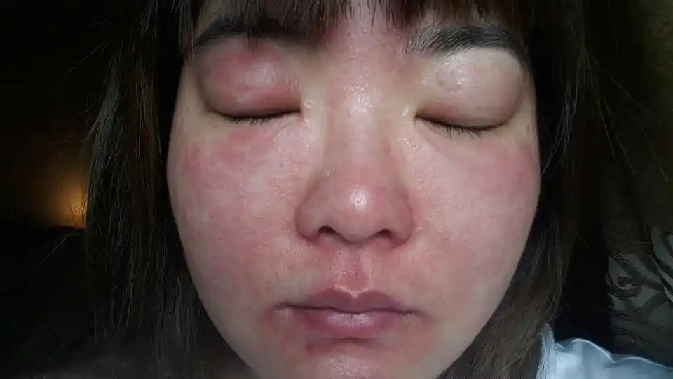 皮肤过敏是一种过敏原刺激皮肤造成的变态反应,是过敏原直接或间接