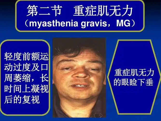 常见疾病病因与治疗方法——重症肌无力