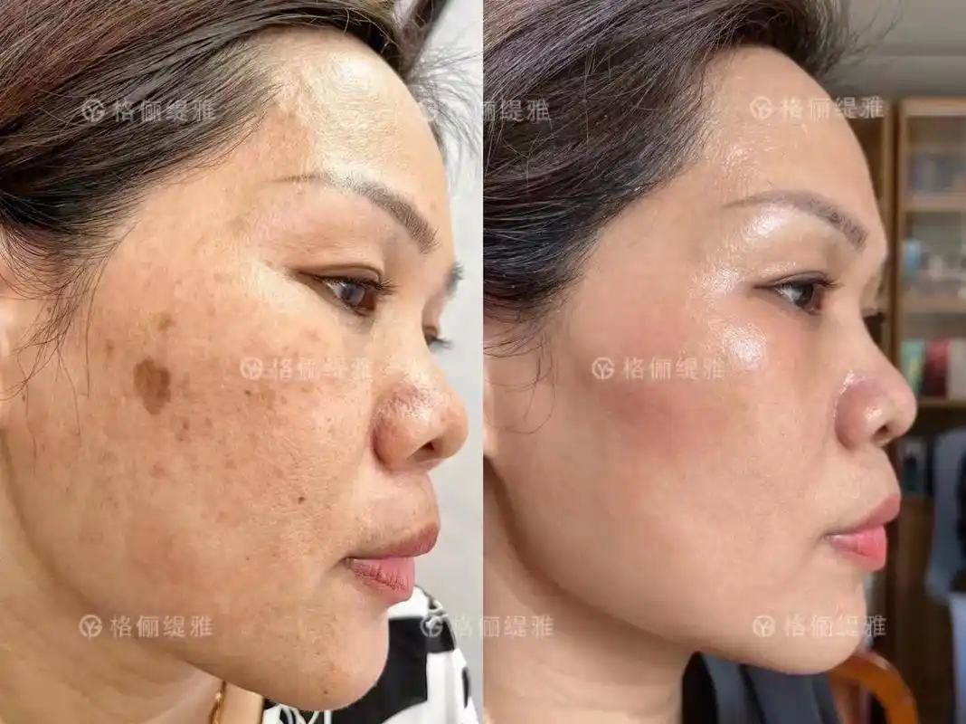 黄褐斑皮肤暗黄毛孔粗大,一次效果 - 抖音
