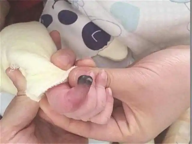 3个月宝宝因为妈妈的粗心被截肢!