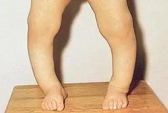 骨密度分析仪浅谈儿童佝偻病