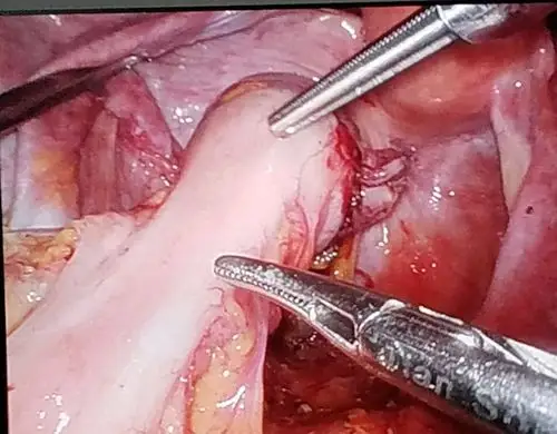 这标志着我科在结直肠癌诊疗道路上又向进迈进一步