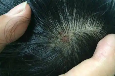 为何头皮总长"脓包"和"疙瘩"?医生坦言:4种病要考虑在内