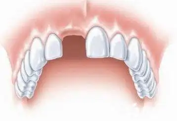 而假牙的种类繁多,价格也各异.