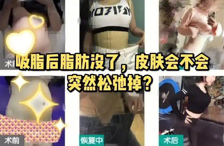 吸脂后脂肪没了皮肤会不会突然松弛掉
