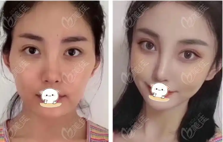 合肥韩美自体脂肪面部填充前后图片对比