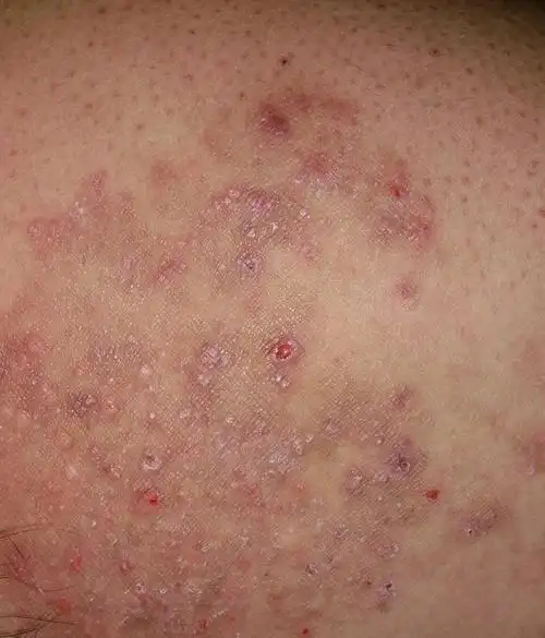 大腿内侧皮肤病2009年左右由于工作原因天热不透风起痱