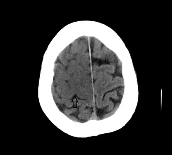 67超急性期大面积脑梗死ct平扫表现