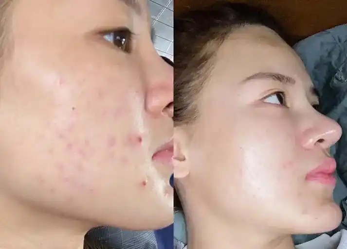 敏感肌反馈 换季皮肤过敏,红肿痒,起小红疹,修复的效果,让肌 - 抖音