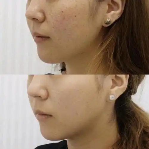 医美祛斑真的有用吗?激光,皮秒,超皮秒哪个最有效?大概多少钱?