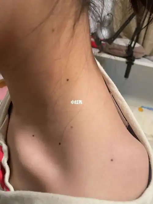 长在脖子上的痣