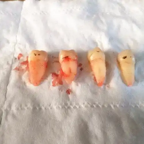 拔掉的牙齿