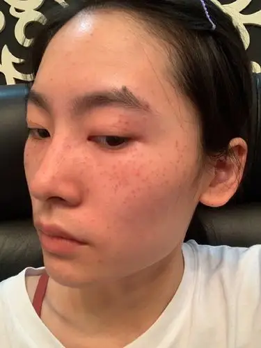 超皮秒 光子嫩肤术后第二天,皮肤泛红,出油出的厉害_圈子-新氧美容整