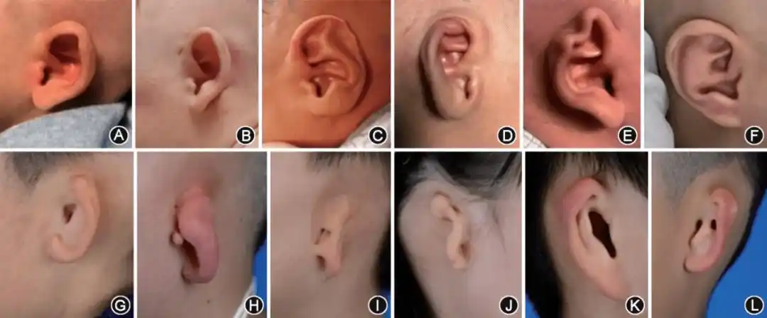 招风耳,猿耳,隐耳,耳轮畸形,耳甲异常凸起型,耳甲粘连型,耳垂型,耳屏