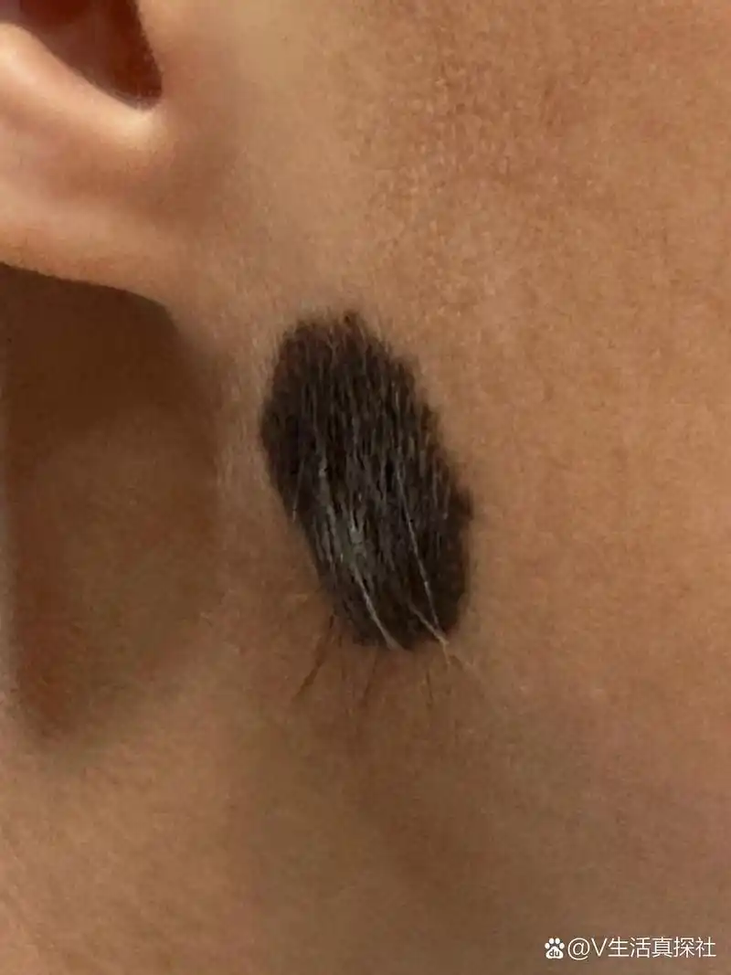 所以俗称黑毛痣痣上长毛发是很正常的,可以用剪刀修剪