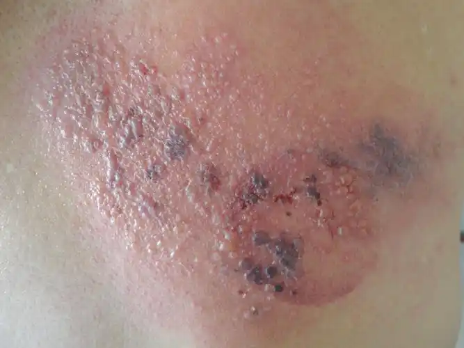 病例分享带状疱疹